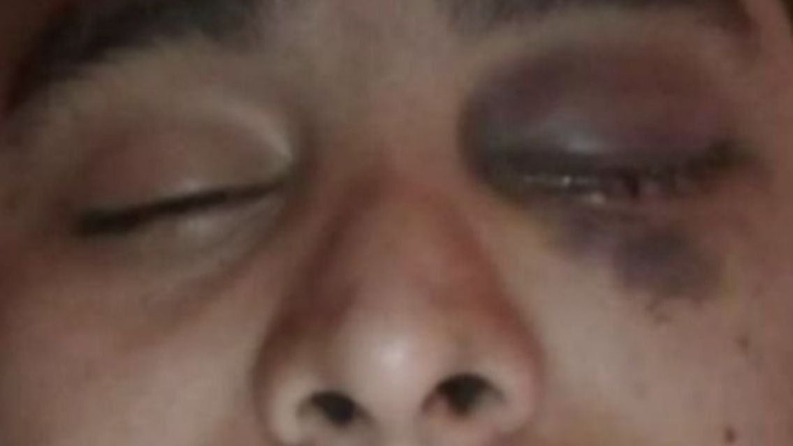 Se atras� dos semanas con el alquiler, el due�o el dio un culatazo y perdi� el ojo