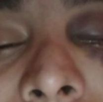 Se atrasó dos semanas con el alquiler, el dueño el dio un culatazo y perdió el ojo