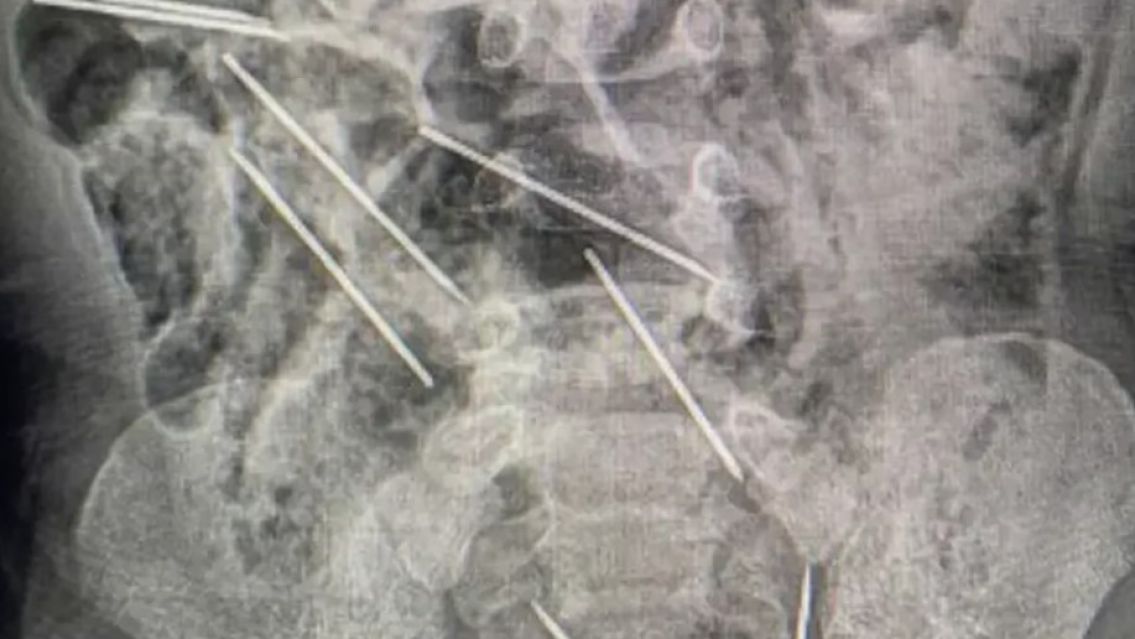 Un beb� se trag� ocho agujas, tuvieron que operarlo de urgencia y est� grave