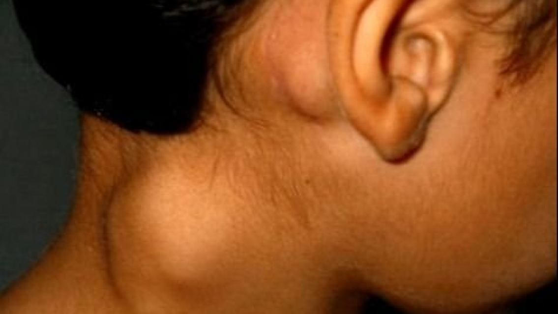 Linfoma y leucemia mieloide crónica: dos tumores que se pueden controlar