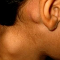 Linfoma y leucemia mieloide cr&oacute;nica: dos tumores que se pueden controlar