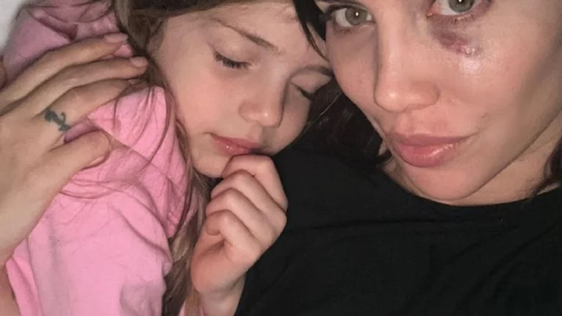 Wanda Nara preocupó al mostrar moretones, cómo sigue su situación con la leucemia