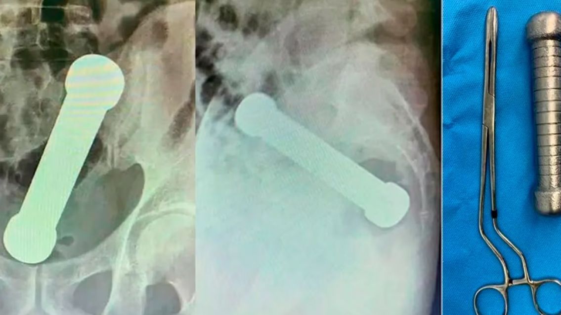 Se puso "goloso" y tuvieron que operarlo para sacarle una mancuerna del cuerpo