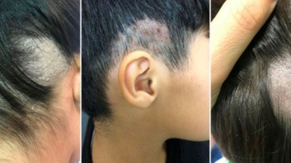 Todo mal: aumentaron los contagios por el llamado "hongo de las barber�as"