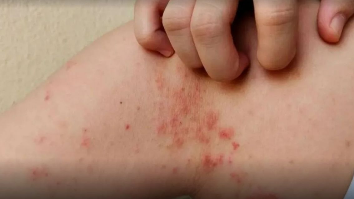 Qu� edad tienen los pacientes con lepra 