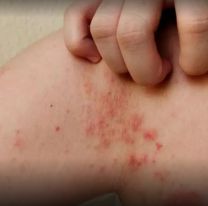 Qué edad tienen los pacientes con lepra