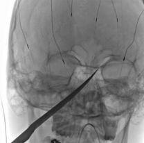 Jujeño discutió con su hermano y uno terminó irreconocible en el hospital