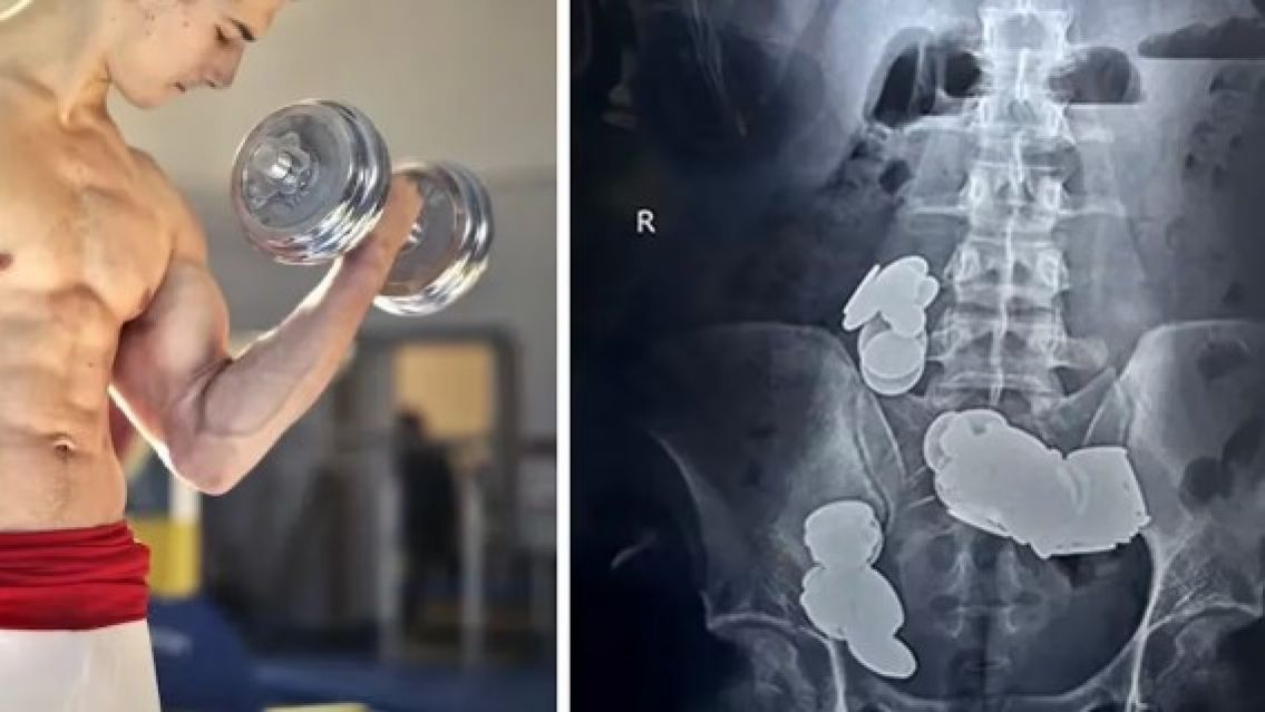 Quería tener "más músculos" y empezo a comer monedas por el "zinc": Casi muere