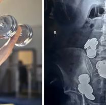 Quería tener "más músculos" y empezo a comer monedas por el "zinc": Casi muere