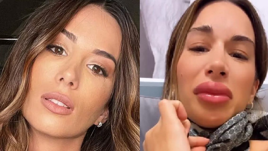 "Alergia al �cido hialur�nico ten�s vos", en las redes no perdonaron a Estefi Berardi