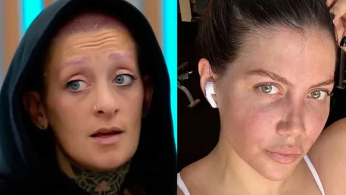 Diagnóstico de Leucemia, cómo son los casos de Wanda Nara y Furia de Gran Hermano