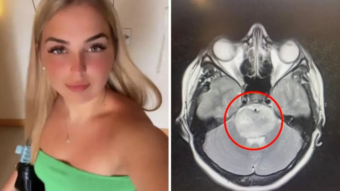 Tenía 18 años y pensó que tenía resaca pero le dieron meses de vida