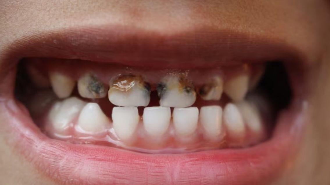 Efecto Milei: Por la crisis los jujeños ya no van al dentista