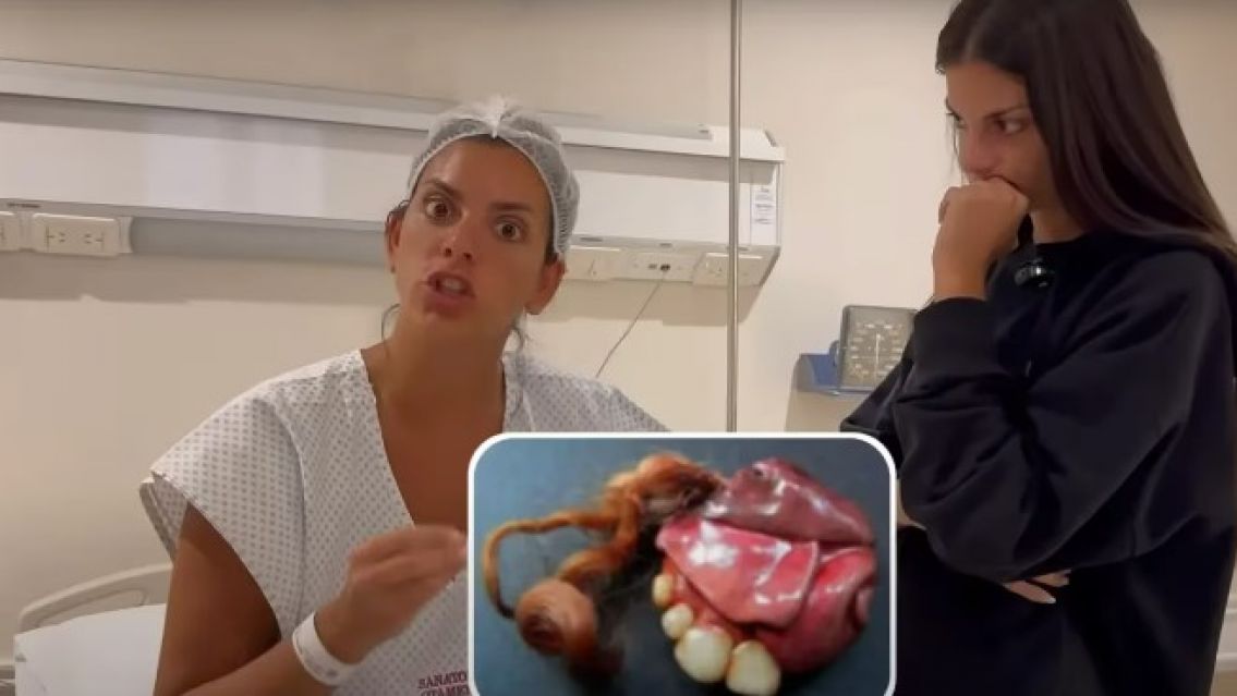 Qu� es un teratoma, el tumor con pelos y dientes que le extirparon a Belu Lucius