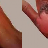 Le tiró soda cáustica en la cara a la actual de su ex y la desfiguró