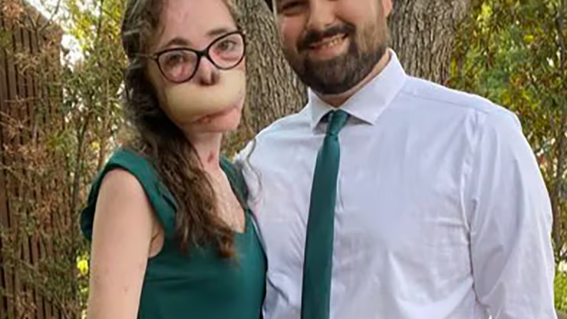 As� qued�: la atacaron perros y le mordieron la cara 800 veces