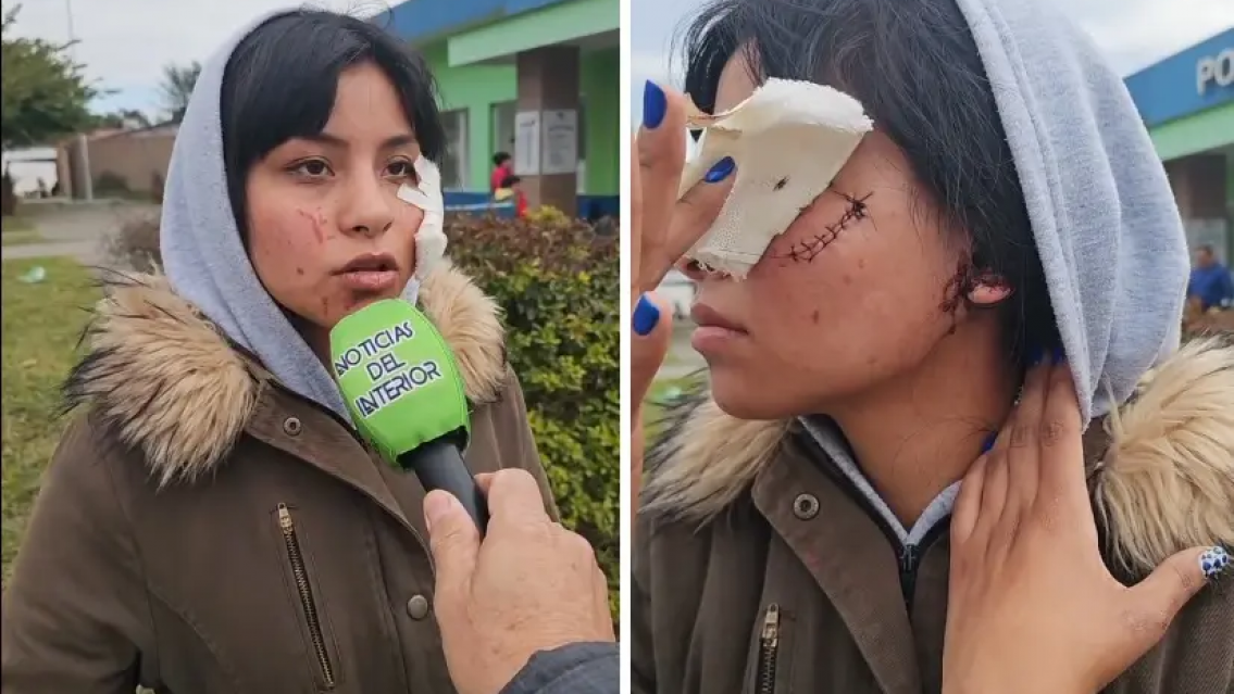 La desfiguraron, norteña relató el horror que vivió a la salida del boliche