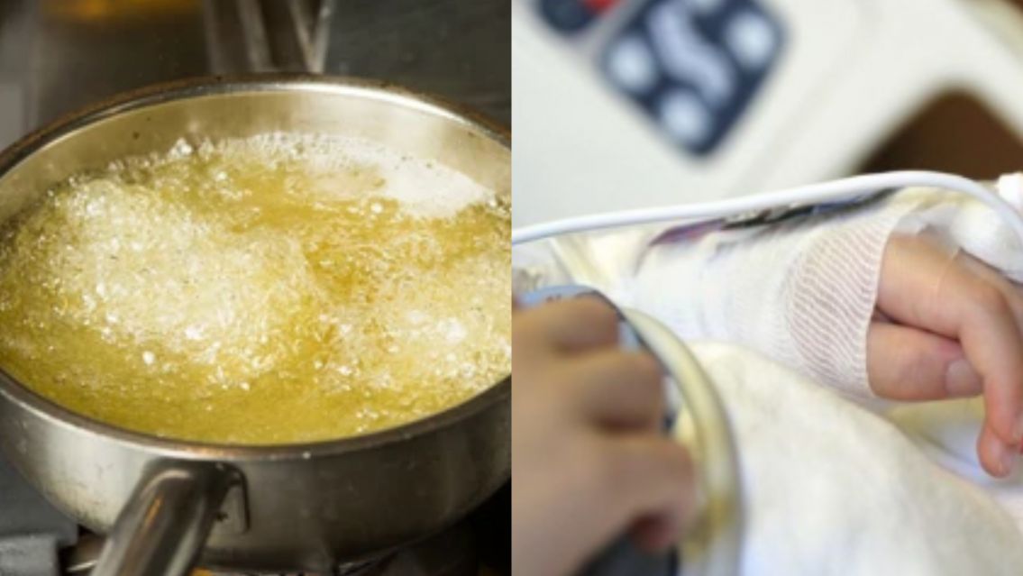 Una sartén con aceite hirviendo cayó sobre un changuito: está en terapia intensiva