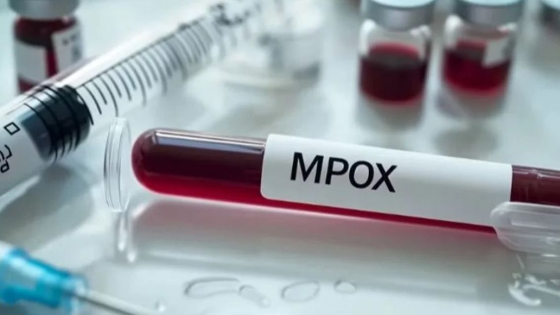 Confirmaron un caso autóctono de viruela del mono en Argentina