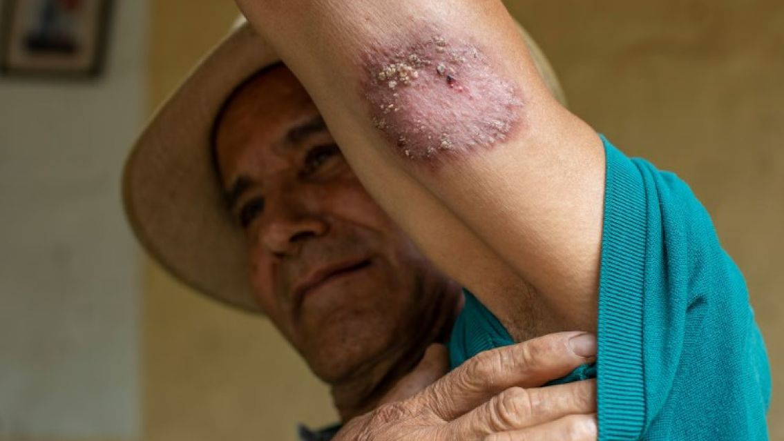 Leishmaniasis en Jujuy: detectaron 11 casos positivos