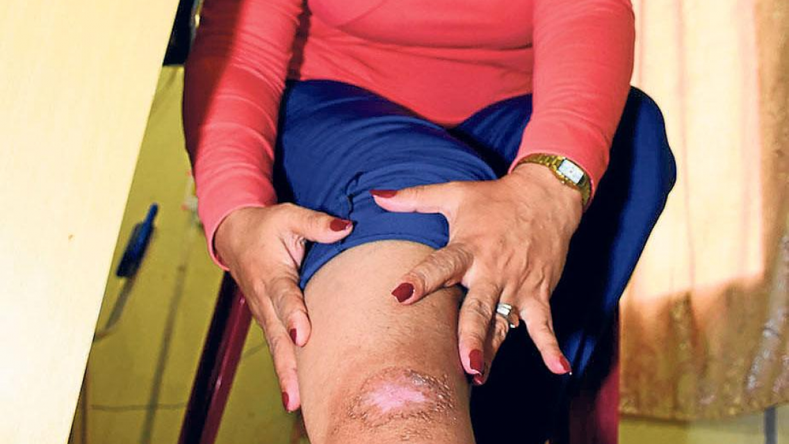 ALERTA LEISHMANIASIS ya hay m�s de 10 casos en Jujuy