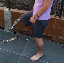 Le dol&iacute;a la panza, fue al hospital y le terminaron amputando una pierna