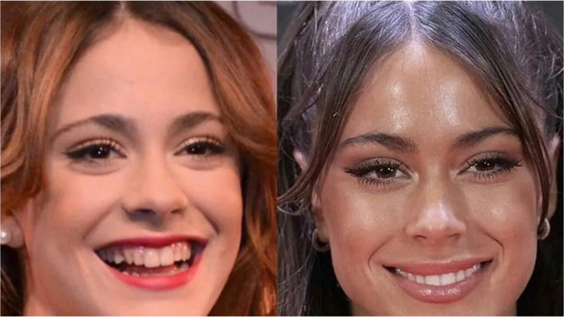 Antes y después de Tini Stoessel contado por su propia cirujana