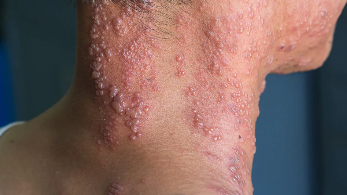 "Aumentaron los casos en Jujuy", la enfermedad de la que te tenés que cuidar