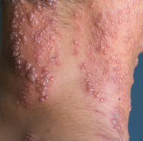 "Aumentaron los casos en Jujuy", la enfermedad de la que te ten&eacute;s que cuidar