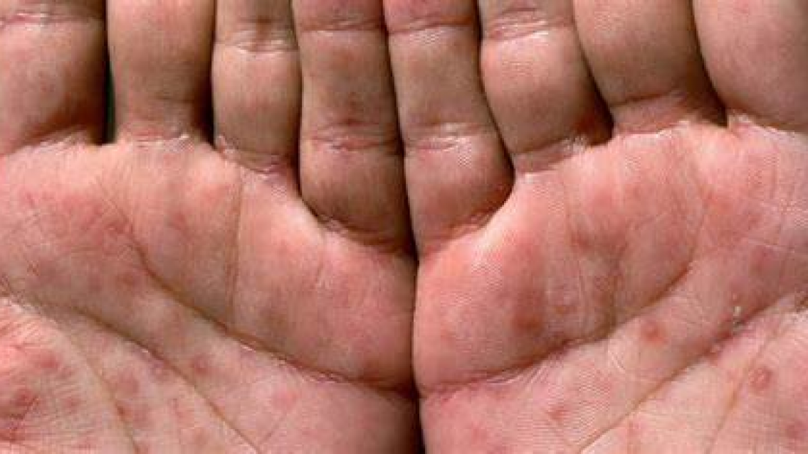 As� se ve la enfermedad que increment� notablemente en Jujuy