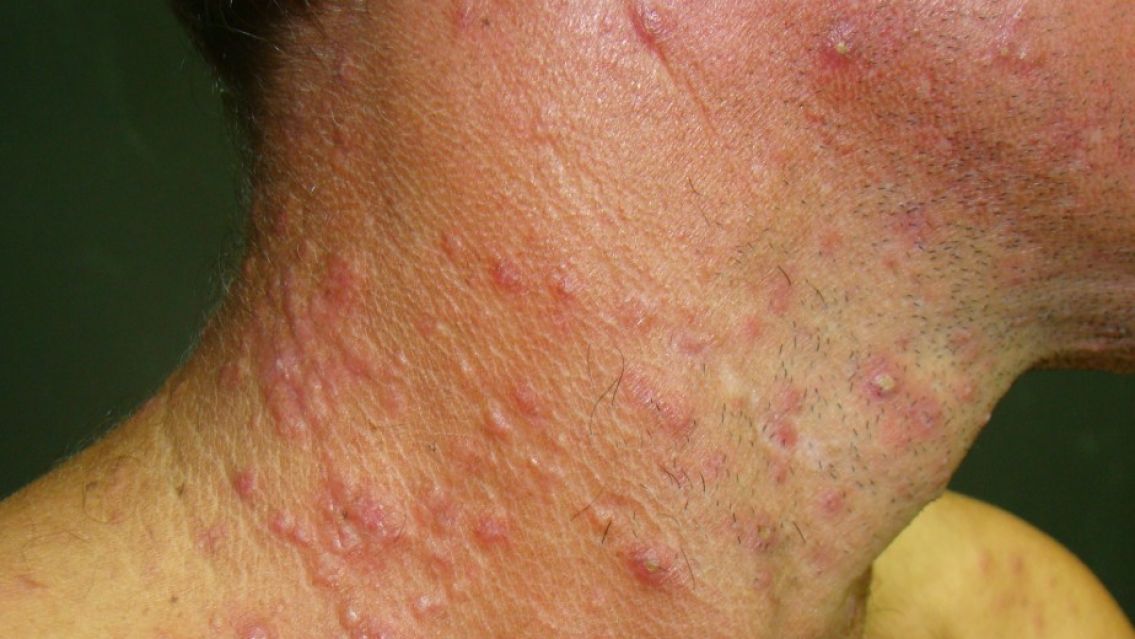 Jujuy entre las provincias con más casos de enfermedaddes de transmisión sexual