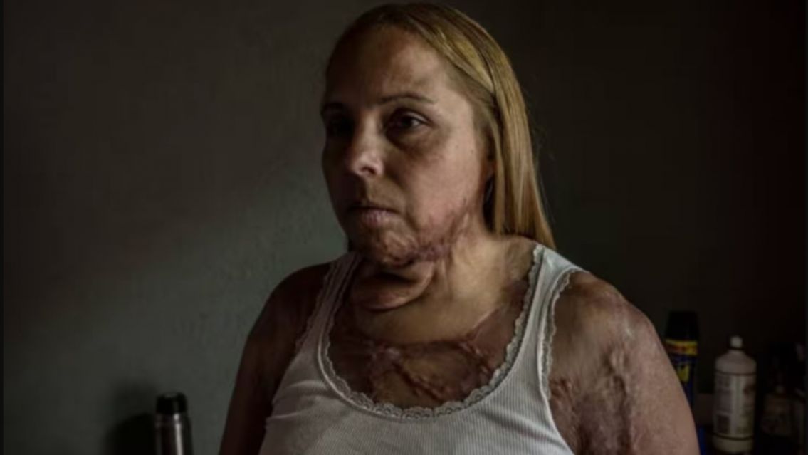 "85 operaciones y casi pierdo los brazos": el infierno que vivió una mujer con su ex pareja