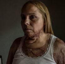 "85 operaciones y casi pierdo los brazos": el infierno que vivió una mujer con su ex pareja