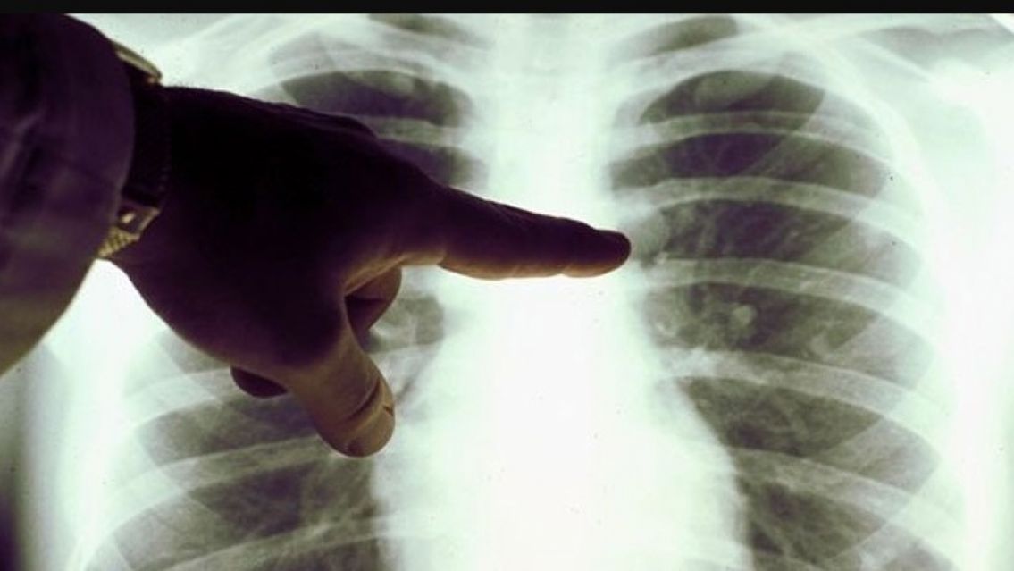 Crecen los casos de cáncer de pulmón en no fumadores