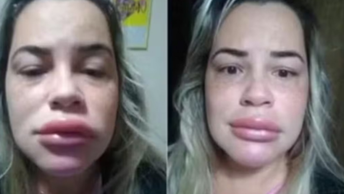 Fue a ponerse ácido hialurónico pero la estafaron: así quedó