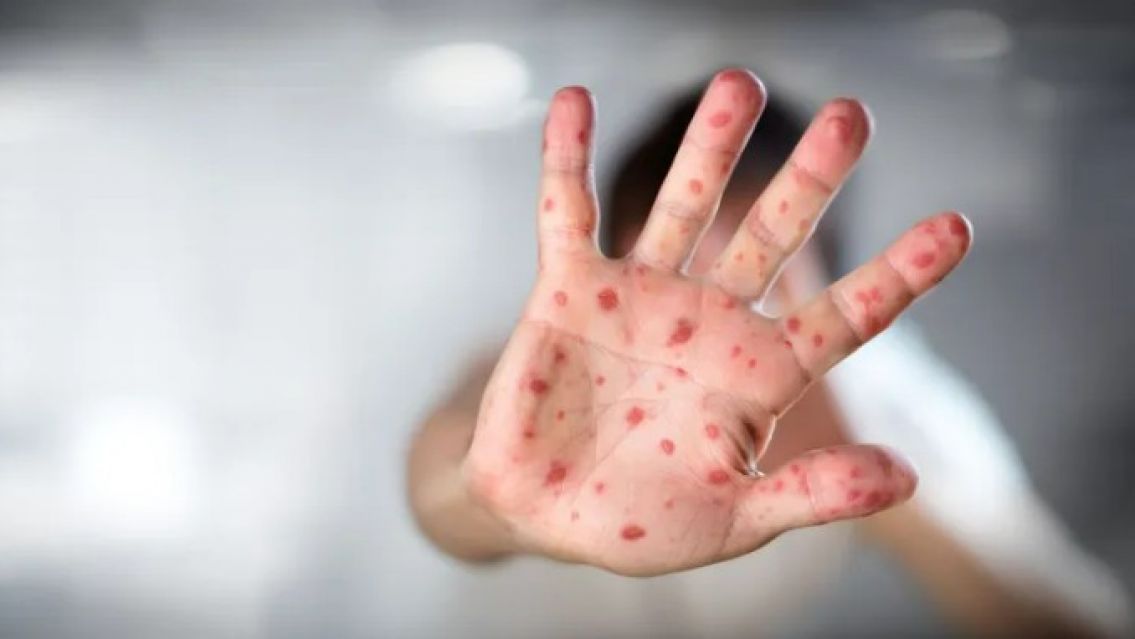 Alerta por sarampión: ¿Cómo y dónde vacunarse en Jujuy?