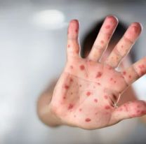 Alerta por sarampi&oacute;n: &iquest;C&oacute;mo y d&oacute;nde vacunarse en Jujuy?