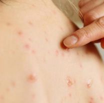 Preocupaci&oacute;n por el Sarampi&oacute;n en Jujuy: "La &uacute;nica soluci&oacute;n es la vacunaci&oacute;n"