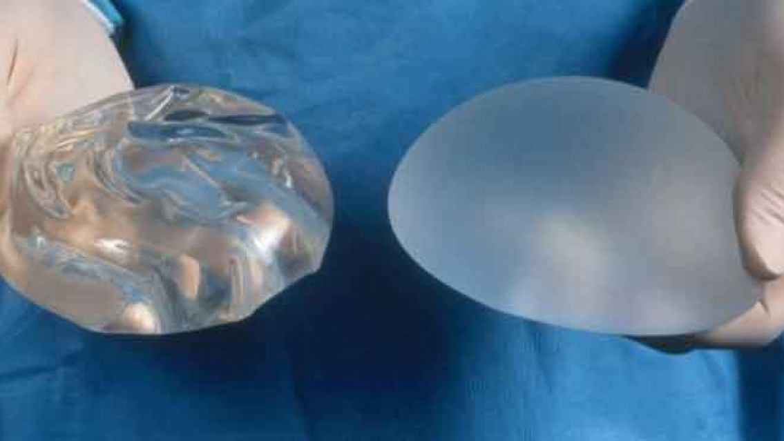 Empleado de una cl�nica rob� implantes mamarios y dijo que "eran para su novia"