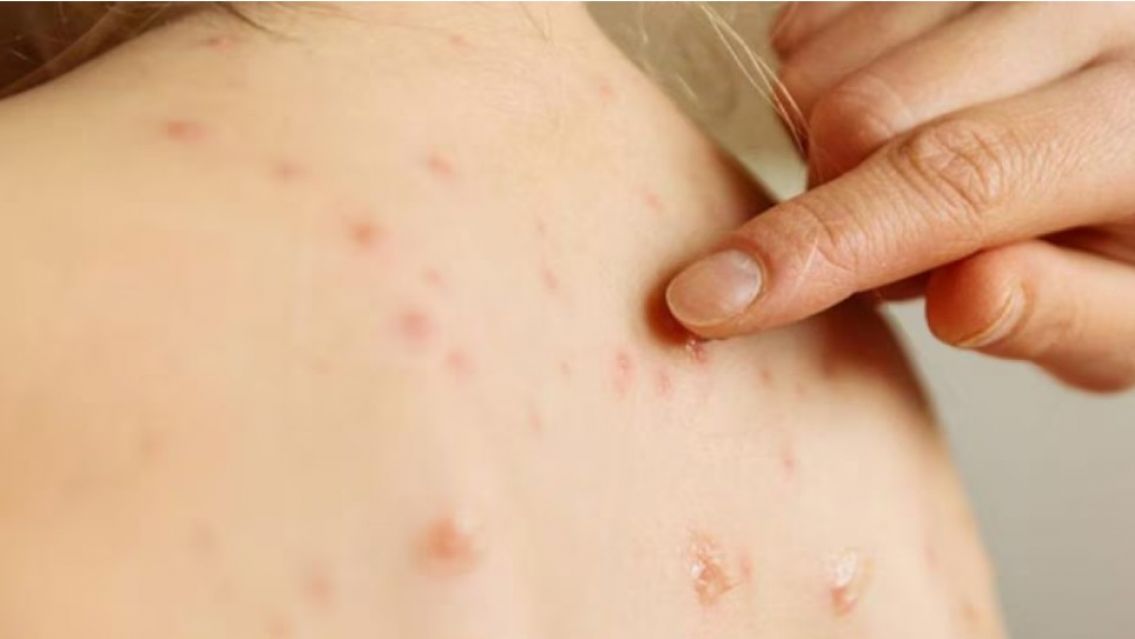 Alarma por el brote de sarampi�n: crecen los casos y hay preocupaci�n por los contagios