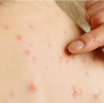Alarma por el brote de sarampión: crecen los casos y hay preocupación por los contagios