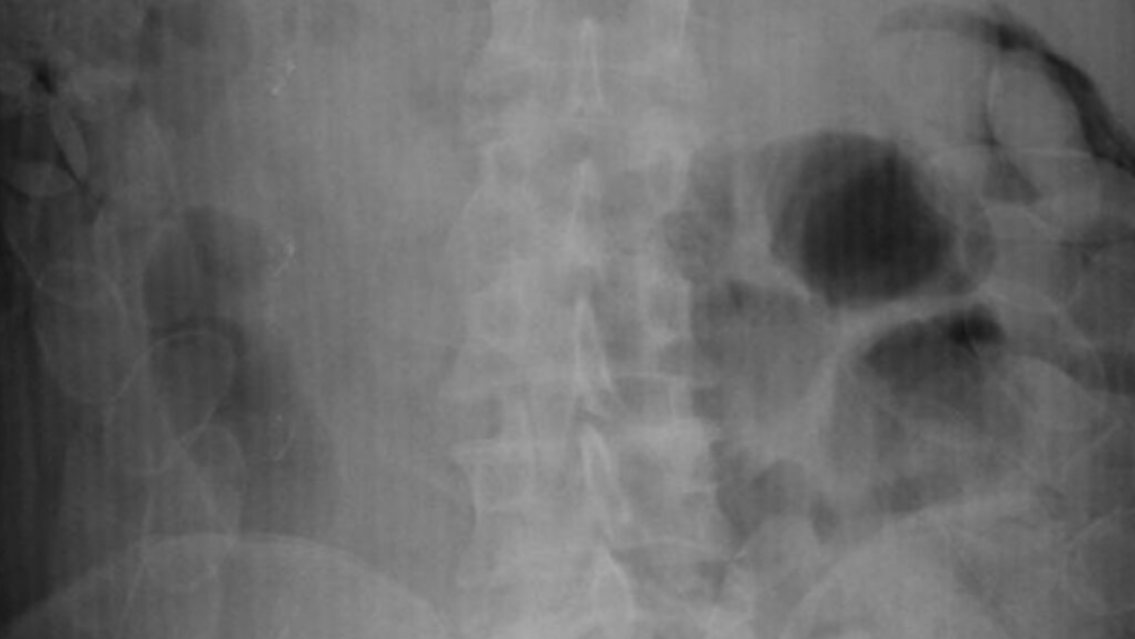 Viajaba de Bolivia a Jujuy y quedó internada: se metió al cuerpo 20 cápsulas de droga