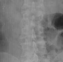 Viajaba de Bolivia a Jujuy y qued&oacute; internada: se meti&oacute; al cuerpo 20 c&aacute;psulas de droga