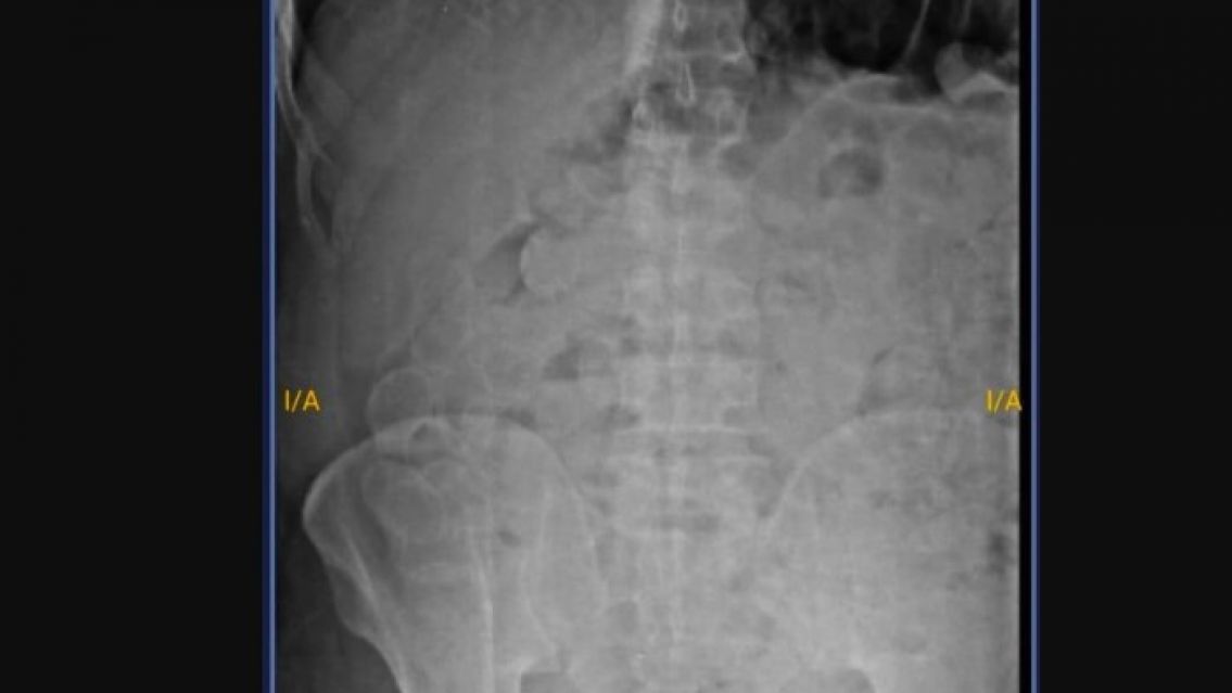 Preso se meti� 180 c�psulas con droga en una salida transitoria