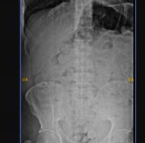 Preso se metió 180 cápsulas con droga en una salida transitoria