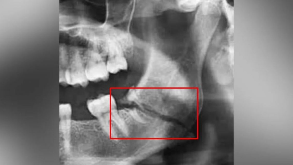 Jujeño enloqueció y le rompió la mandibula a su ex: Quedó internada