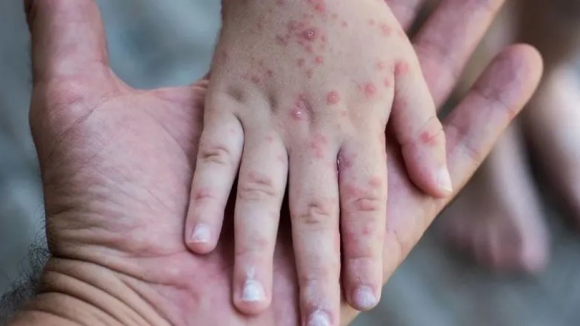 Alerta en La Quiaca por un brote de sarampi�n en Bolivia: �C�mo cuidarse?