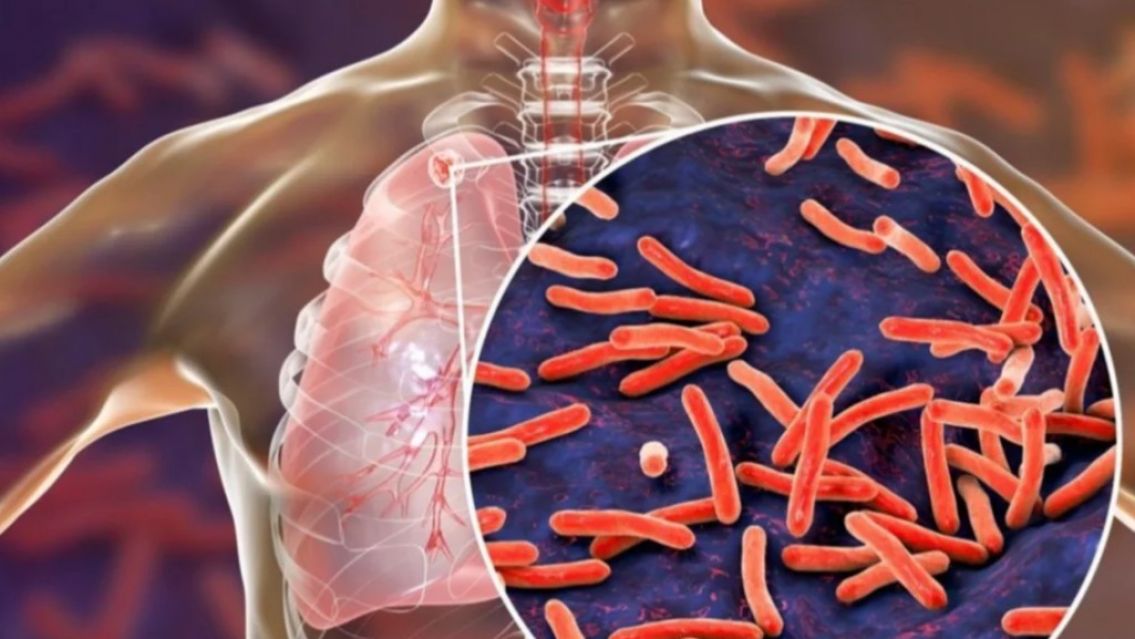 Crece la preocupación por el aumento de casos de Tuberculosis en Argentina