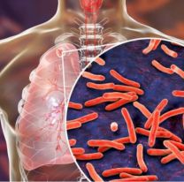 Crece la preocupación por el aumento de casos de Tuberculosis en Argentina