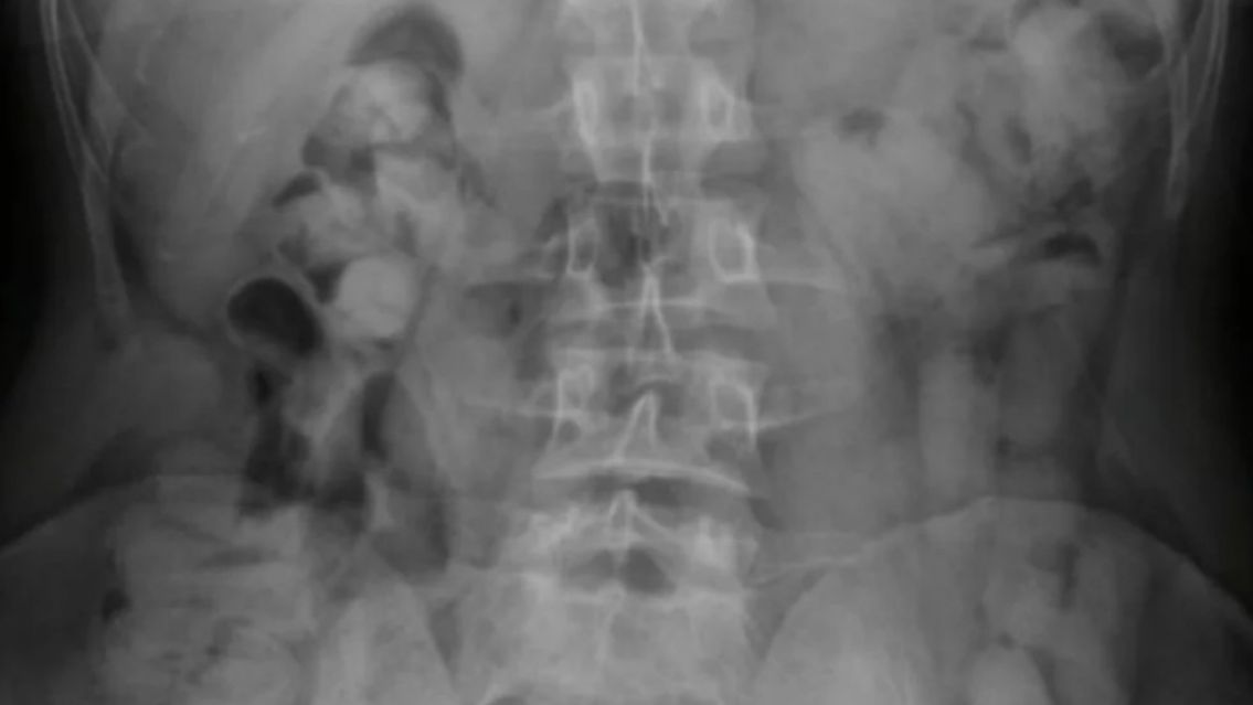 Tres ciudadanos bolivianos quedaron detenidos por ingerir 235 cápsulas con cocaína